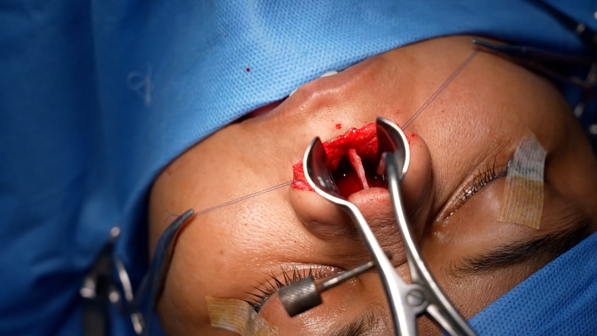 (REV RHINO)surgery